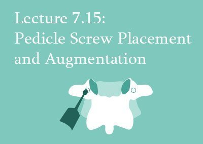 7.15 Pedicle Screw Placement and Augmentation