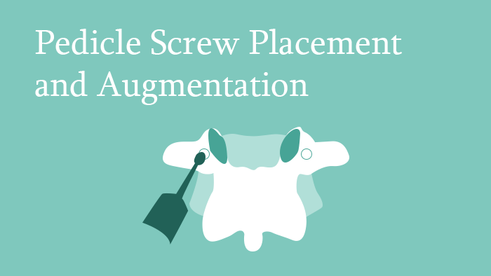 Pedicle Screw Placement and Augmentation Lecture Thumbnail