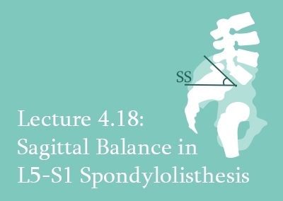 4.18 Sagittal Balance in L5-S1 Spondylolisthesis