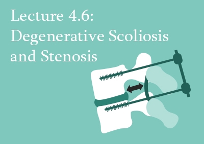 4.6 Degenerative Scoliosis and Stenosis