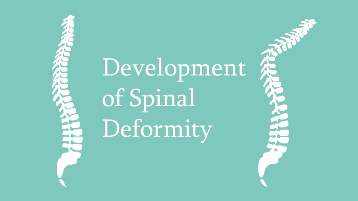 Development of Spinal Deformity Lecture Thumbnail