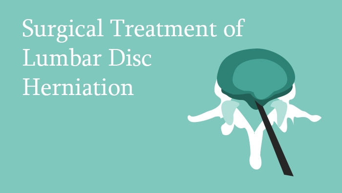 Surgical Treatment of Lumbar Disc Herniation - Spine Surgery Lecture - Thumbnail