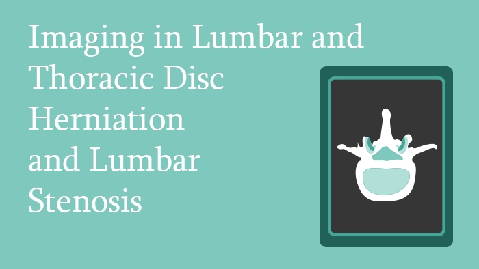 Imaging in Lumbar and Thoracic Disc Herniation and Lumbar Stenosis Lecture Thumbnail