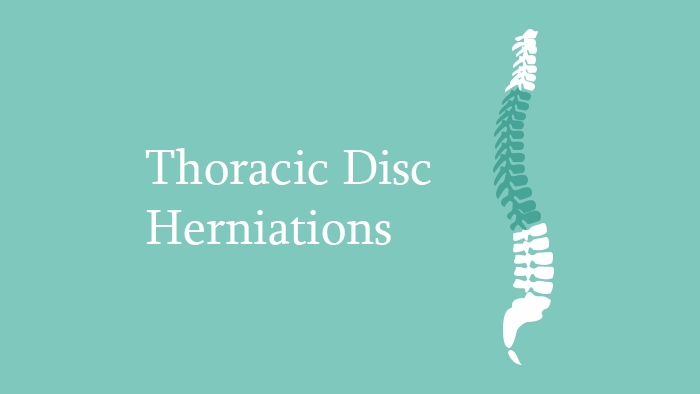 Thoracic Disc Herniations - Spine Surgery Lecture - Thumbnail