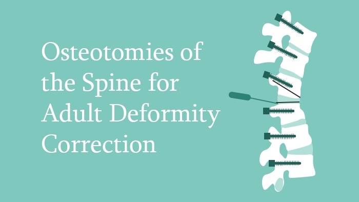 Osteotomies of the Spine lecture thumbnail