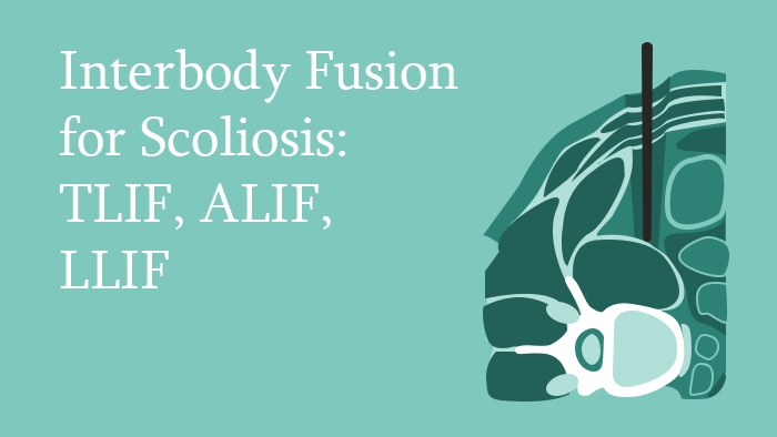 Interbody Fusion for Scoliosis Lecture Thumbnail