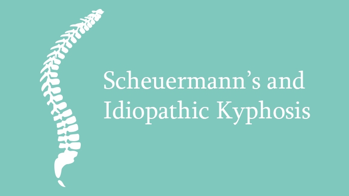 Scheuermann’s and Idiopathic Kyphosis – Clinical Presentation and Natural History Lecture Thumbnail