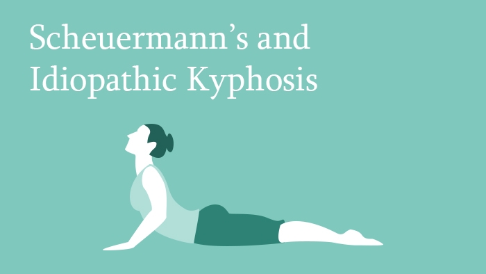 Scheuermann's and Idiopathic Kyphosis Outcome Lecture Thumbnail