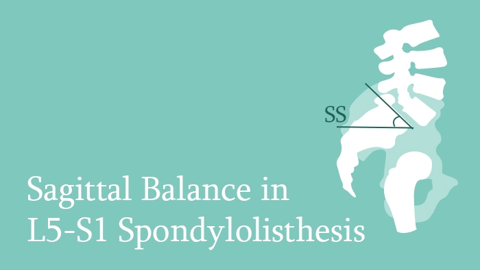Sagittal Balance in L5-S1 Spondylolisthesis Lecture Thumbnail