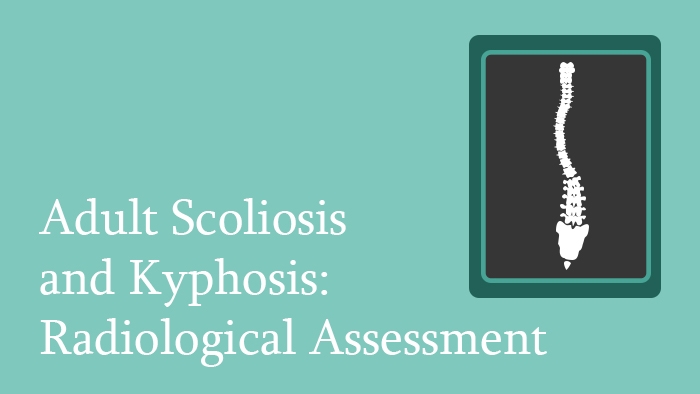 Adult Scoliosis and Kyphosis: Radiological Assessment Lecture Thumbnail