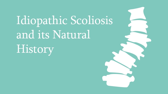 Idiopathic Scoliosis Lecture Thumbnail