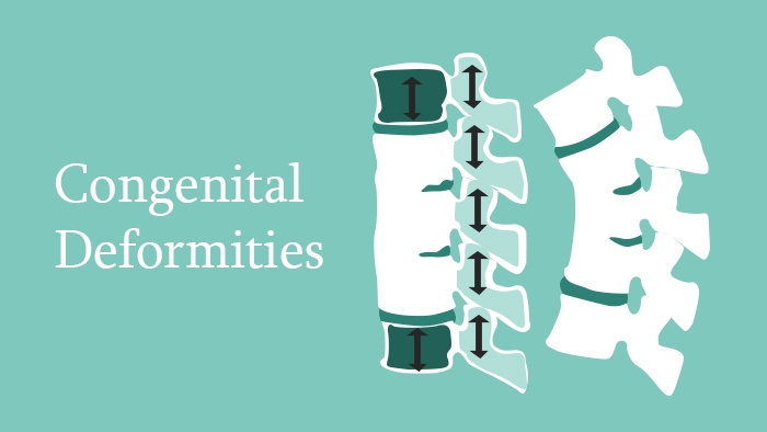 Congenital Deformities of the Spine - Spine Surgery Lecture - Thumbnail