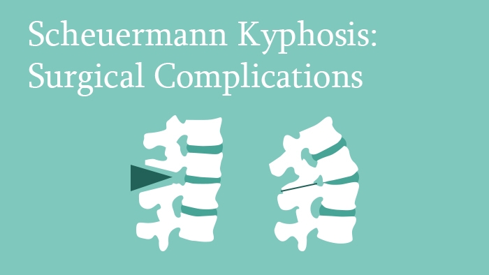 Scheuermann’s Kyphosis: Surgical Complications - Spine Surgery Lecture - Thumbnail