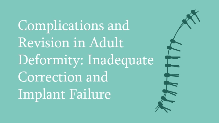Complications and Revision in Adult Deformity: Inadequate Correction and Implant Failure Lecture Thumbnail