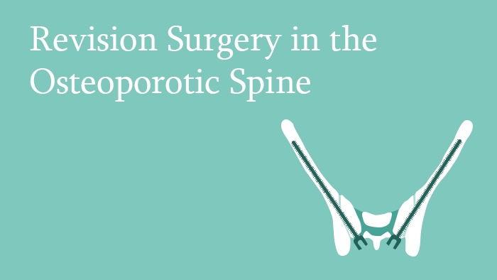 Osteoporotic Spine Revision Surgery Spine Lecture EccElearning