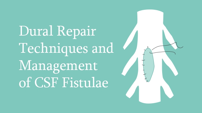 Dural Repair Techniques and Management of CSF Fistulae Lecture Thumbnail