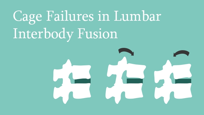 Cage Failures in Lumbar Interbody Fusion lecture thumbnail
