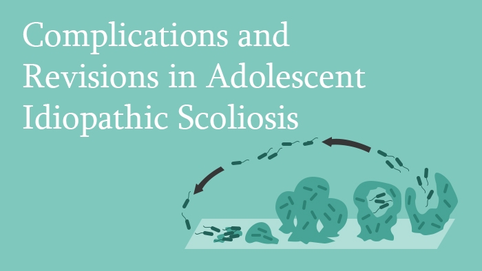 Complications and revisions in surgery of adolescent idiopathic scoliosis lecture thumbnail