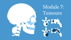 Module 7: Spinal Tumours