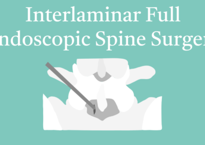 10.13 Interlaminar Full Endoscopic Spine Surgery