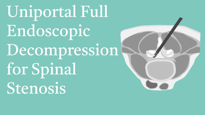 Uniportal Full Endoscopic Decompression for Spinal Stenosis Lecture