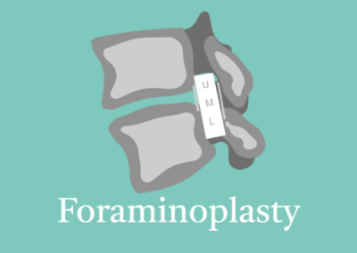 10.4 Foraminoplasty
