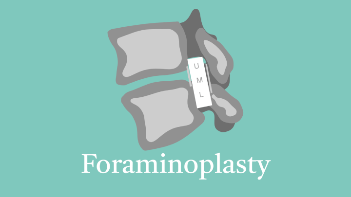 Foraminoplasty Lecture