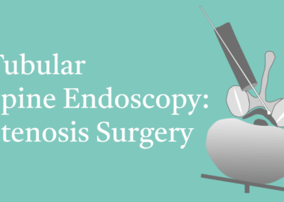 10.6 Tubular Spine Endoscopy: Stenosis Surgery