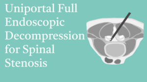 10.14 Uniportal Full Endoscopic Decompression for Spinal Stenosis