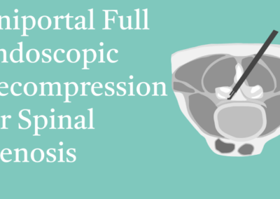 10.14 Uniportal Full Endoscopic Decompression for Spinal Stenosis